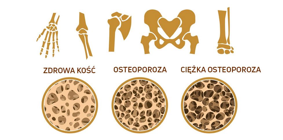 Badanie osteoporozy - Ilustracja etapów osteoporozy i miejsc jej występowania