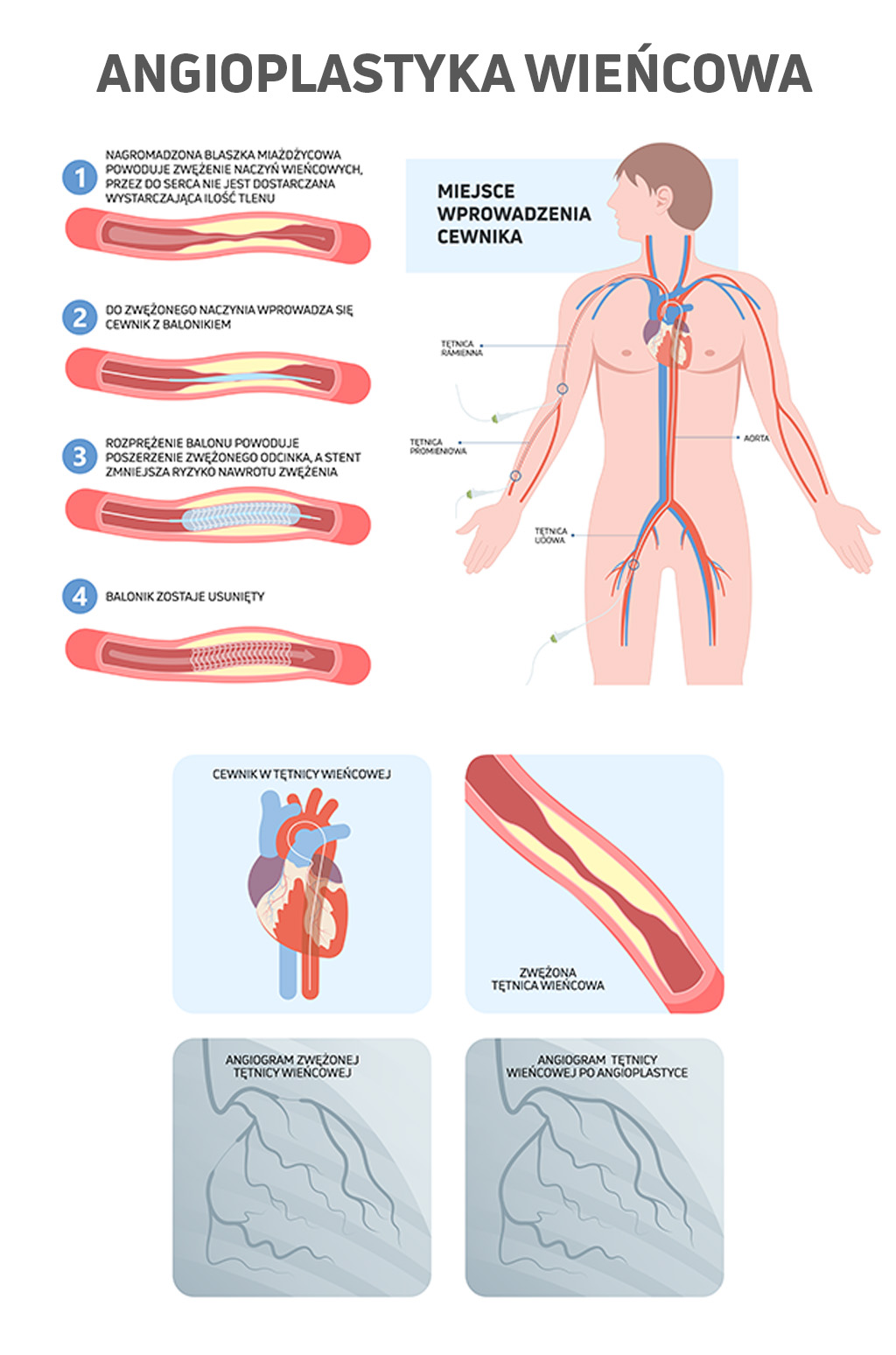 Ilustracja pokazująca na czym polega leczenie choroby niedokrwiennej serca przy pomocy angioplastyki wieńcowej