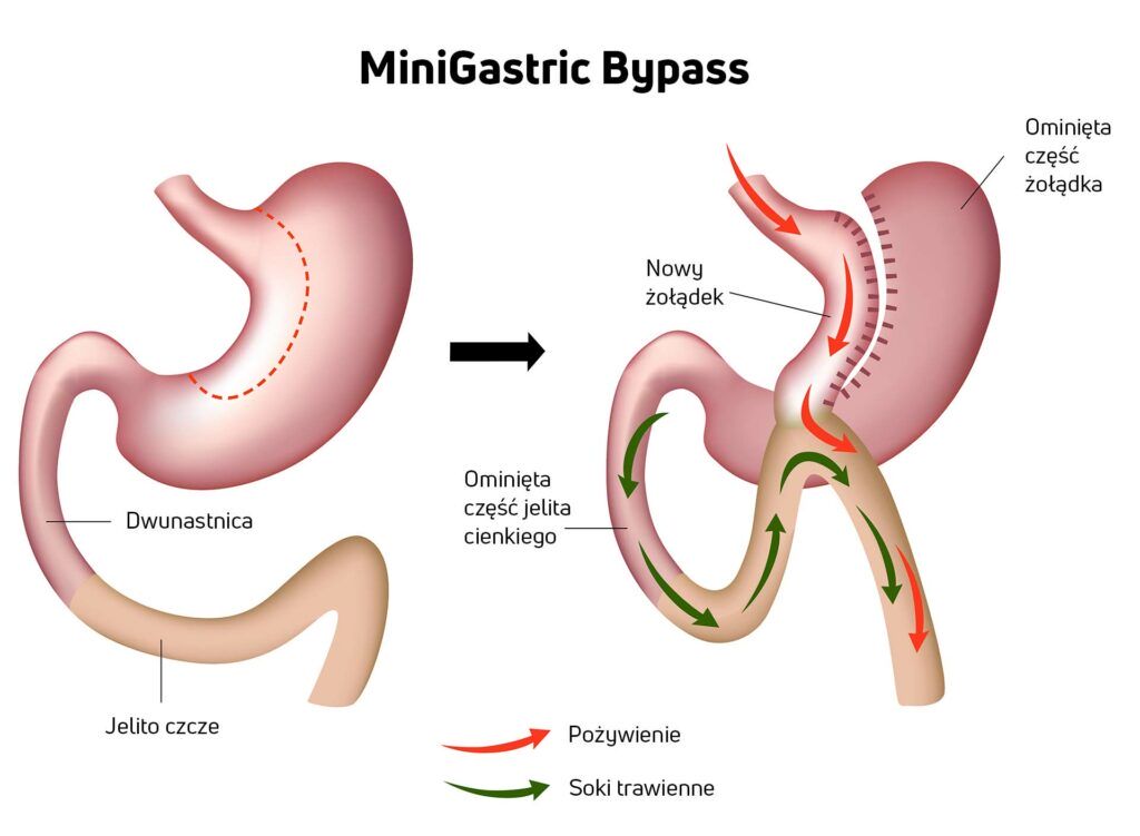 Ilustracja przedstawiająca operację bariatryczną - MiniGastric Bypass