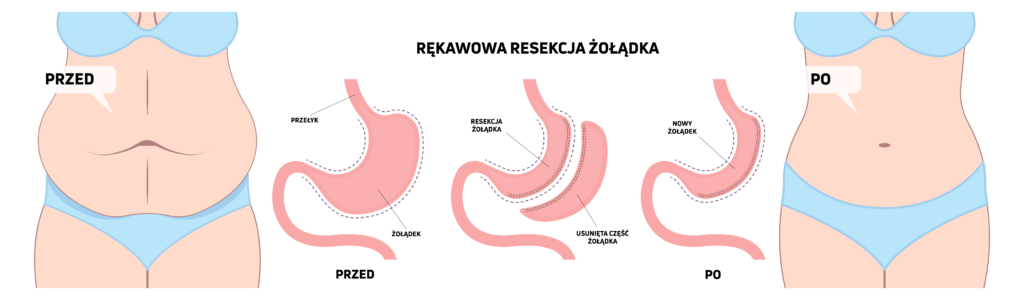 Ilustracja przedstawiająca operację bariatryczną - Rękawowa resekcja żołądka