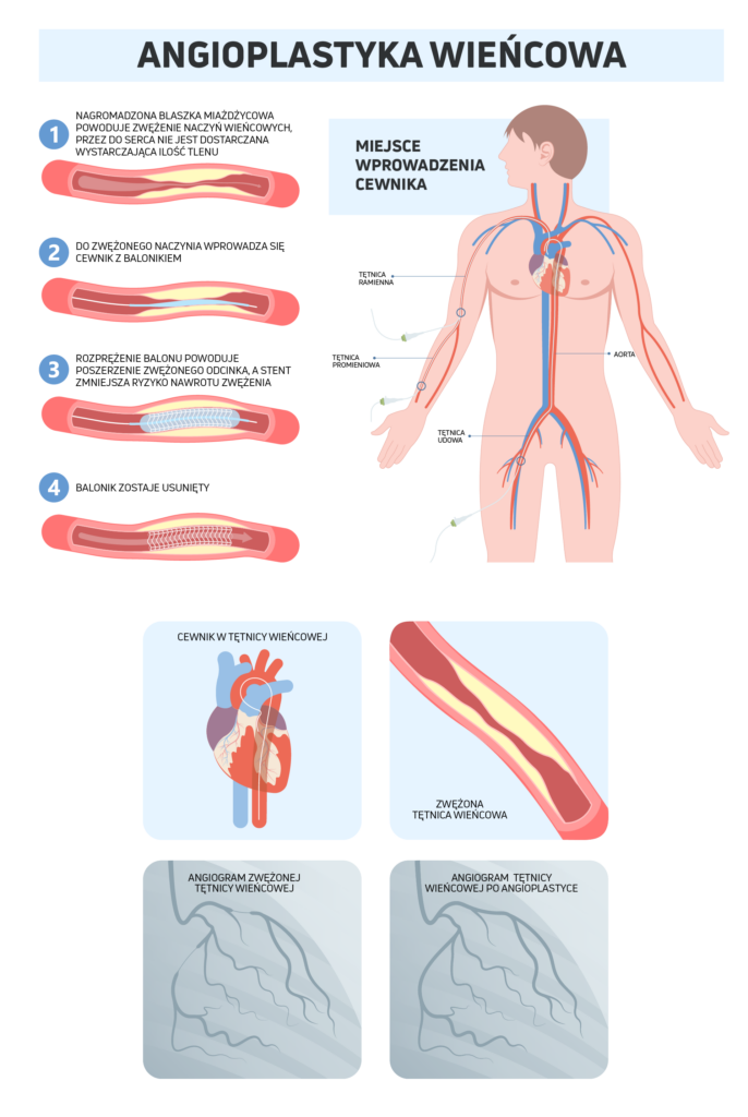 Ilustracja pokazująca na czym polega leczenie choroby niedokrwiennej serca przy pomocy angioplastyki wieńcowej