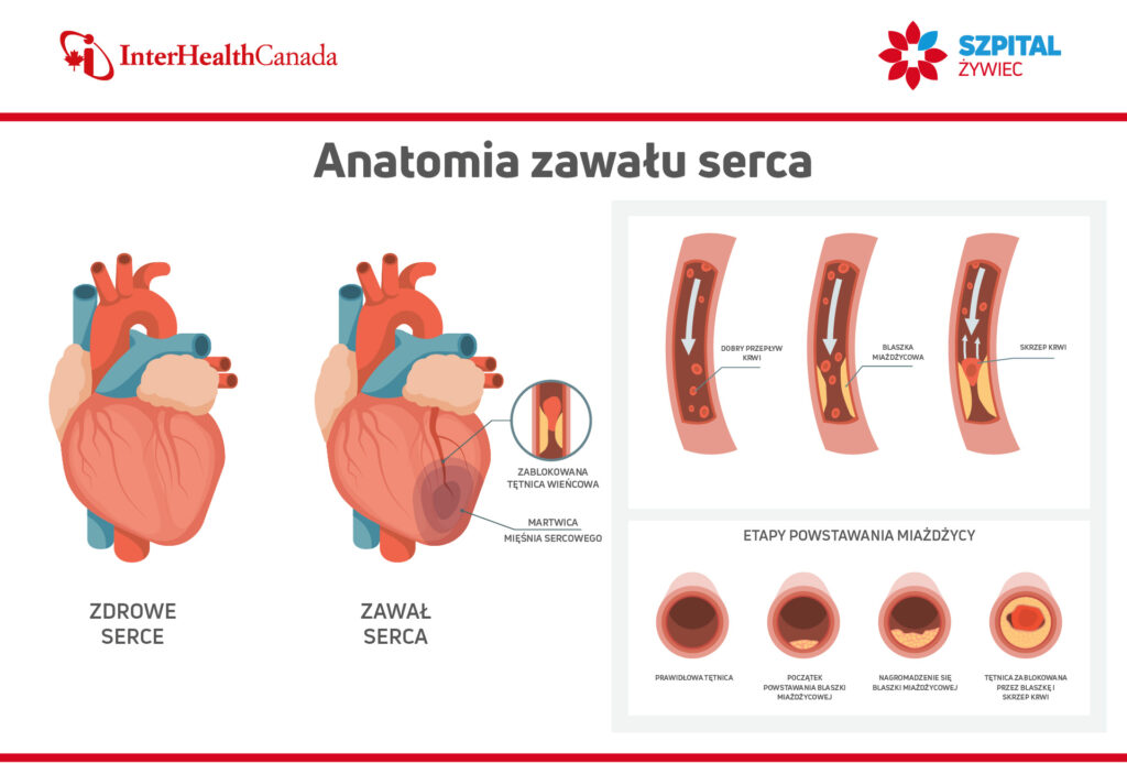 Ilustracja pokazująca na czym polega zawał serca oraz proces powstawania miażdżycy tętnic wieńcowych